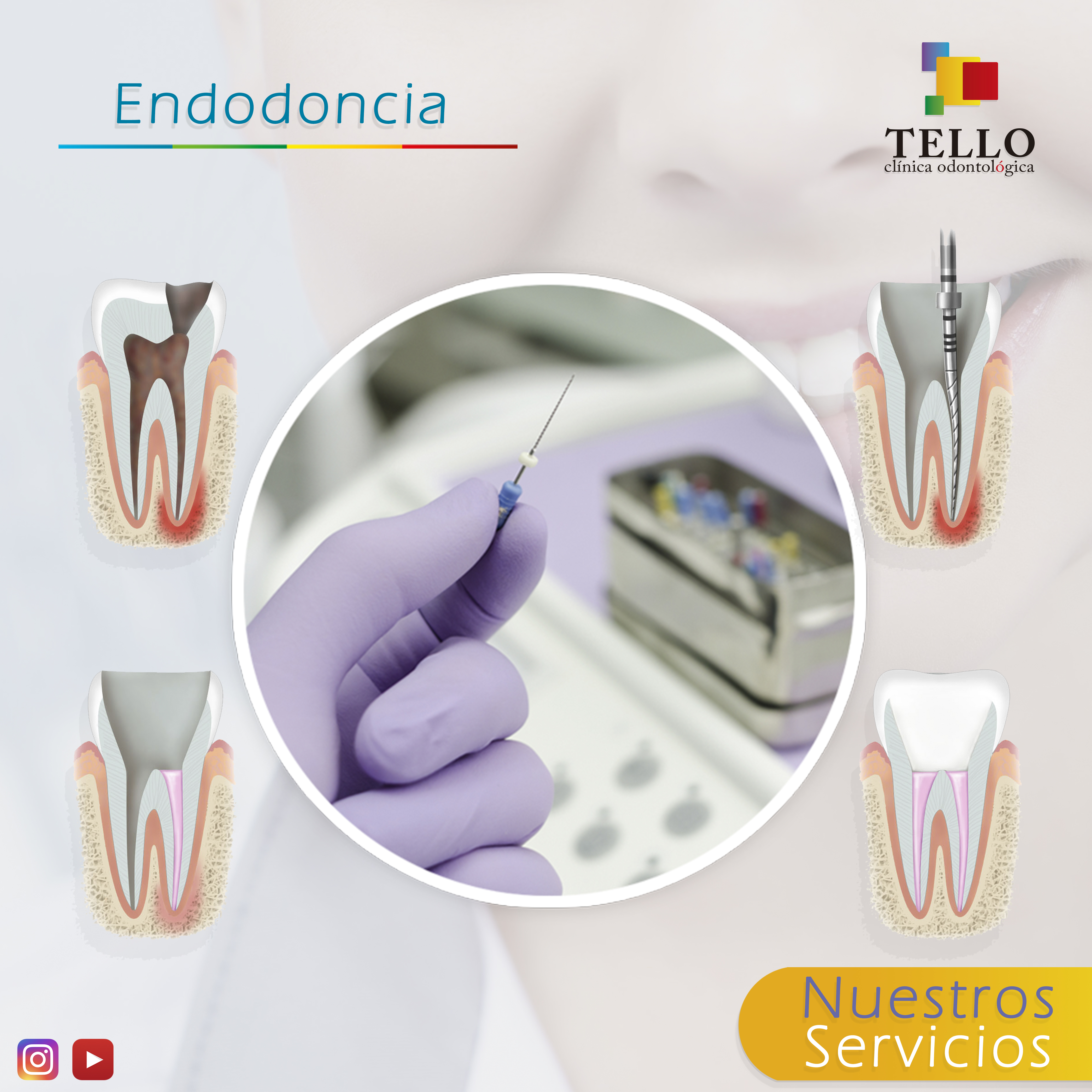Endodoncia Tello Odontología